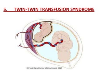 5.   TWIN-TWIN TRANSFUSION SYNDROME
 
