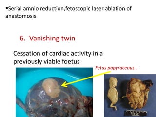 Serial amnio reduction,fetoscopic laser ablation of
anastomosis


     6. Vanishing twin
   Cessation of cardiac activity in a
   previously viable foetus
                                     Fetus papyraceous…
 