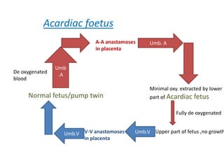 Acardiac foetus
                            A-A anastamoses    Umb. A
                            in placenta


                Umb
De oxygenated
                 .A
blood
                                               Minimal oxy. extracted by lower
     Normal fetus/pump twin                    part of Acardiac fetus

                                                          Fully de oxygenated


                  Umb.V V-V anastomoses   Umb.V Upper part of fetus ,no growth
                        in placenta
 