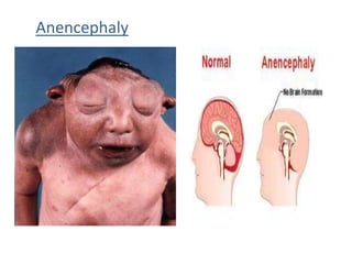 Anencephaly
 