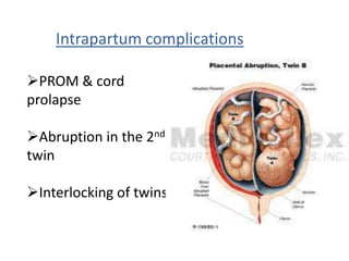 Intrapartum complications

PROM & cord
prolapse

Abruption in the 2nd
twin

Interlocking of twins
 