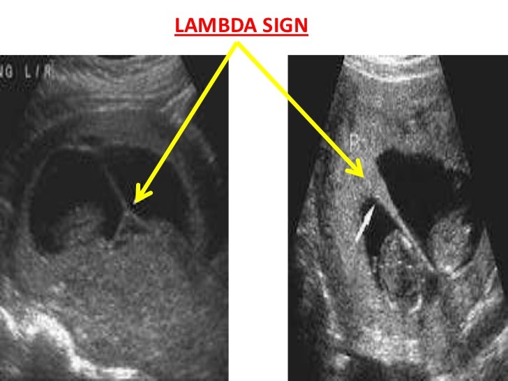 photo Lambda Sign Pregnancy multiple pregnancy