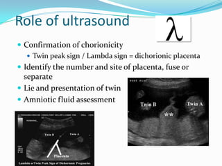 Role of ultrasound
 Confirmation of chorionicity
 Twin peak sign / Lambda sign = dichorionic placenta
 Identify the number and site of placenta, fuse or

separate
 Lie and presentation of twin
 Amniotic fluid assessment

 