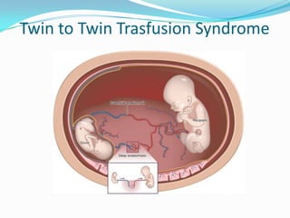Twin to Twin Trasfusion Syndrome

 