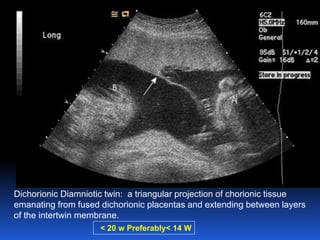 Dichorionic Diamniotic twin: a triangular projection of chorionic tissue
emanating from fused dichorionic placentas and extending between layers
of the intertwin membrane.
< 20 w Preferably< 14 W
 