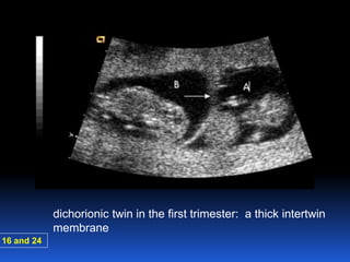 dichorionic twin in the first trimester: a thick intertwin
membrane
16 and 24
 
