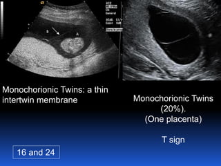Monochorionic Twins: a thin
intertwin membrane
16 and 24
Monochorionic Twins
(20%).
(One placenta)
T sign
 