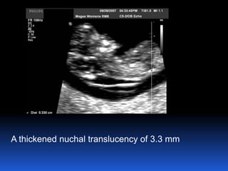 A thickened nuchal translucency of 3.3 mm
 