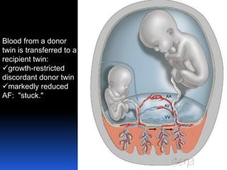Blood from a donor
twin is transferred to a
recipient twin:
growth-restricted
discordant donor twin
markedly reduced
AF: "stuck."
 