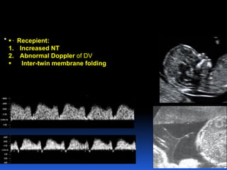  . Recepient:
1. Increased NT
2. Abnormal Doppler of DV
 Inter-twin membrane folding
 