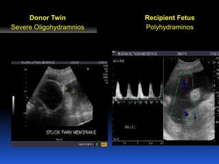 Donor Twin
Severe Oligohydramnios
Recipient Fetus
Polyhydraminos
 