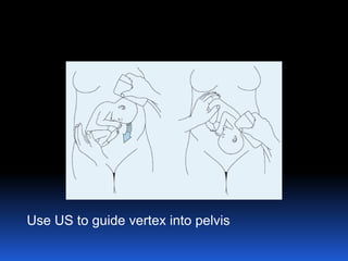 Use US to guide vertex into pelvis
 