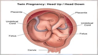 Multiple pregnancy | PPTX