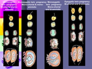 Dyzygotic twin pregnancy
Bi-chorial and bi-amniotic
Monozygotic twin pregnancy
Mono-chorial & mono-
amniotic
Monozygotic
twin pregnancy
Mono-chorial
and bi-amniotic.
Monozygotic
twin pregnancy
Bi-chorial and bi-
amniotic
 