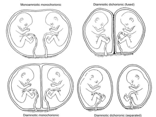 Results from division ofResults from division of
fertilized eggfertilized egg::
0-72 H. Diamniotic0-72 H. Diamniotic
dichorionic.dichorionic.
4-8 days Diamniotic4-8 days Diamniotic
monochor.monochor.
9-12 days9-12 days
Monoamnio.monochor.Monoamnio.monochor.
>12 days Conjoined>12 days Conjoined
 