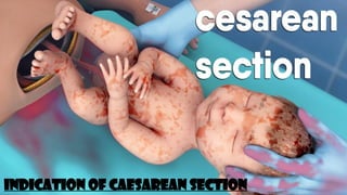 INDICATION OF CAESAREAN SECTION
 