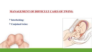 MANAGEMENT OF DIFFICULT CASES OF TWINS:
Interlocking:
Conjoined twins:
 