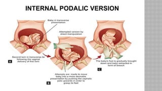 Multiple pregnancy (2).pptx Obstetrics and Gynaecology | PPTX