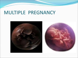 Multiple pregnancy by tanoj patidar