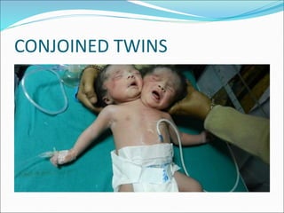 Multiple pregnancy by tanoj patidar