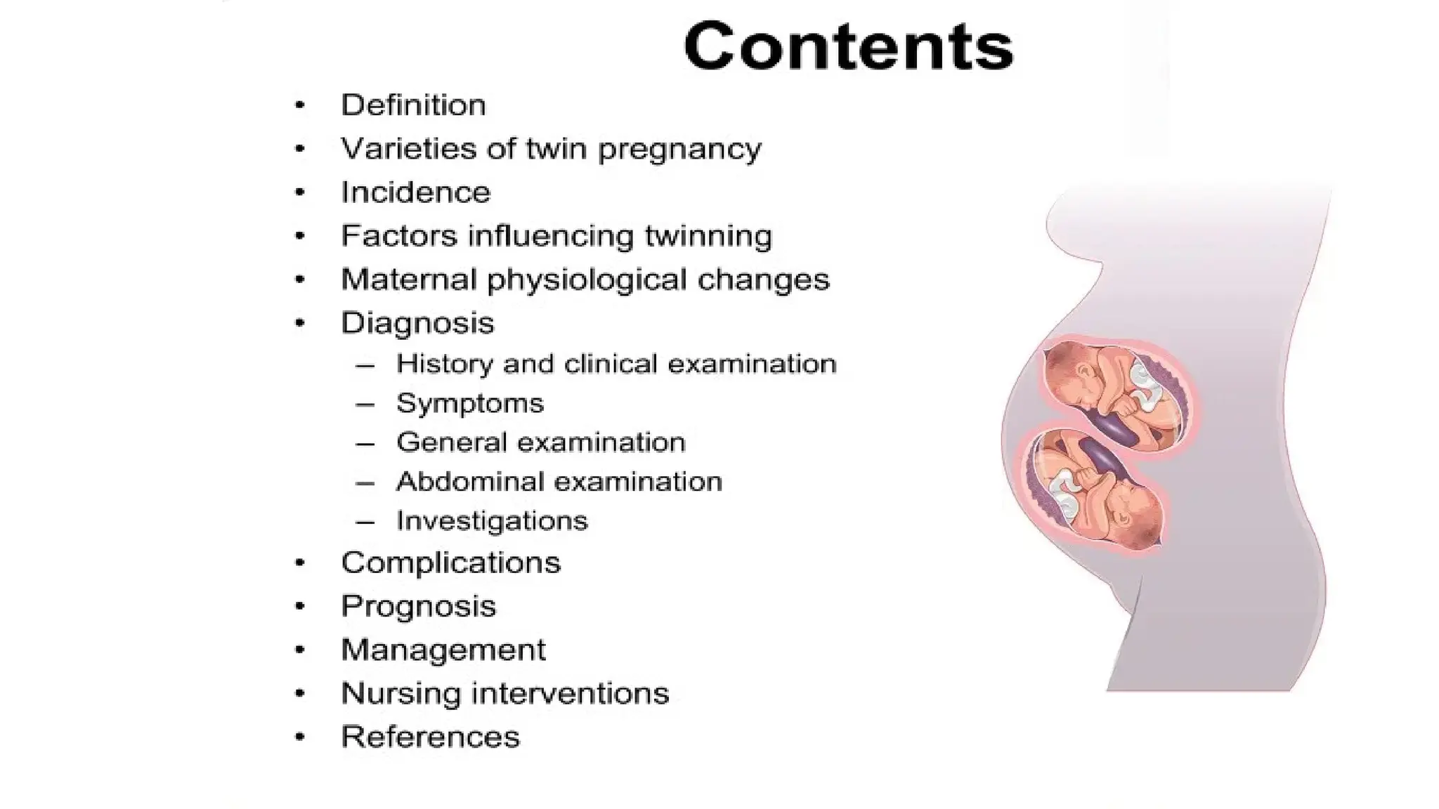 Multiple Pregnancy Lecture Ppt Twin Gestation Ppt