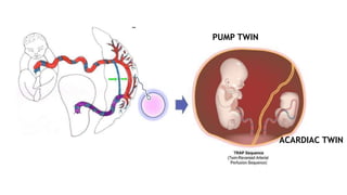 PUMP TWIN
ACARDIAC TWIN
 