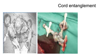 Cord entanglement
 
