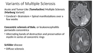 Multiple sclerosis for mbbs final year students | PPTX
