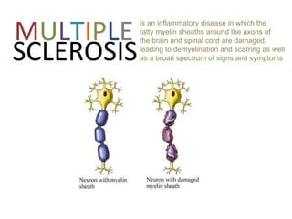 Ms Multiple sclerosis | PPT