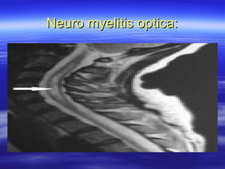 Neuro myelitis optica:
 