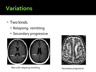 Two kinds Relapsing- remitting  Secondary progressive  Man with relapsing-remitting  Secondary progressive 