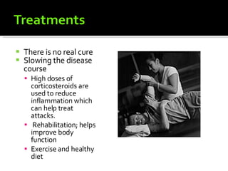 There is no real cure Slowing the disease course  High doses of corticosteroids are used to reduce inflammation which can help treat attacks. Rehabilitation; helps improve body function  Exercise and healthy diet  