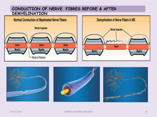 Demyelinating Process Demyelinating diseases | PPTX