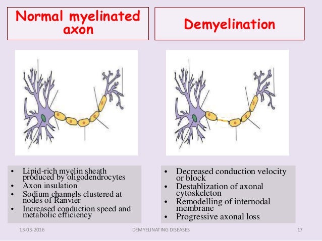 Demyelinating diseases