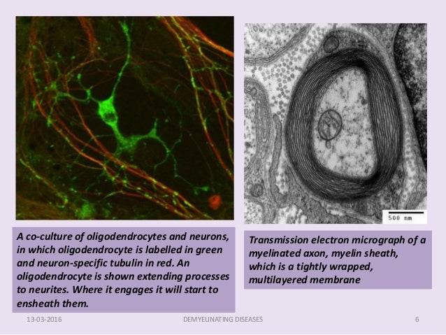 Demyelinating diseases