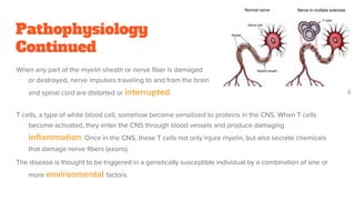 Pathophysiology
Continued
When any part of the myelin sheath or nerve fiber is damaged
or destroyed, nerve impulses traveling to and from the brain
and spinal cord are distorted or interrupted.
T cells, a type of white blood cell, somehow become sensitized to proteins in the CNS. When T cells
become activated, they enter the CNS through blood vessels and produce damaging
inflammation. Once in the CNS, these T cells not only injure myelin, but also secrete chemicals
that damage nerve fibers (axons).
The disease is thought to be triggered in a genetically susceptible individual by a combination of one or
more environmental factors.
 