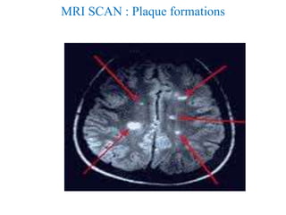 MRI SCAN : Plaque formations
 