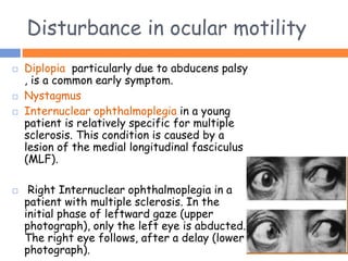 Disturbance in ocular motility
 Diplopia particularly due to abducens palsy
, is a common early symptom.
 Nystagmus
 Internuclear ophthalmoplegia in a young
patient is relatively specific for multiple
sclerosis. This condition is caused by a
lesion of the medial longitudinal fasciculus
(MLF).
 Right Internuclear ophthalmoplegia in a
patient with multiple sclerosis. In the
initial phase of leftward gaze (upper
photograph), only the left eye is abducted.
The right eye follows, after a delay (lower
photograph).
 