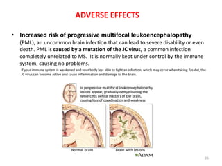 multiplesclerosis-180503132500.pdf