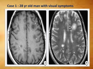Case 1 : 28 yr old man with visual symptoms
 