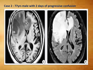 Case 2 : 77yrs male with 2 days of progressive confusion
 
