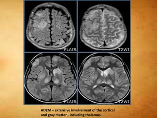 ADEM – extensive involvement of the cortical
and gray matter - including thalamus.
 
