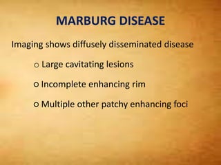 MARBURG DISEASE
Imaging shows diffusely disseminated disease
o Large cavitating lesions
○ Incomplete enhancing rim
○ Multiple other patchy enhancing foci
 