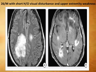 26/M with short H/O visual disturbance and upper extremity weakness
 