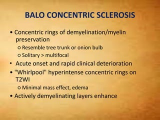 BALO CONCENTRIC SCLEROSIS
• Concentric rings of demyelination/myelin
preservation
○ Resemble tree trunk or onion bulb
○ Solitary > multifocal
• Acute onset and rapid clinical deterioration
• "Whirlpool" hyperintense concentric rings on
T2WI
○ Minimal mass effect, edema
• Actively demyelinating layers enhance
 