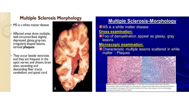 Multiple Sclerosis Types And Treatment