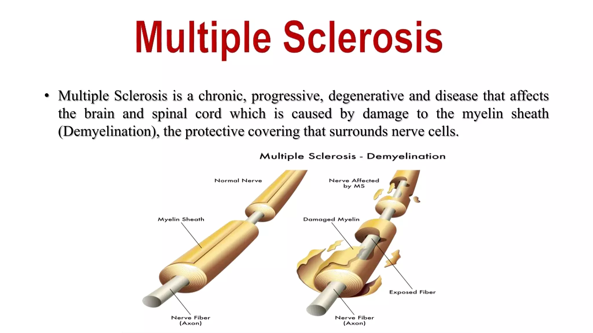 Multiple Sclerosis Process Multiple sclerosis | PPTX