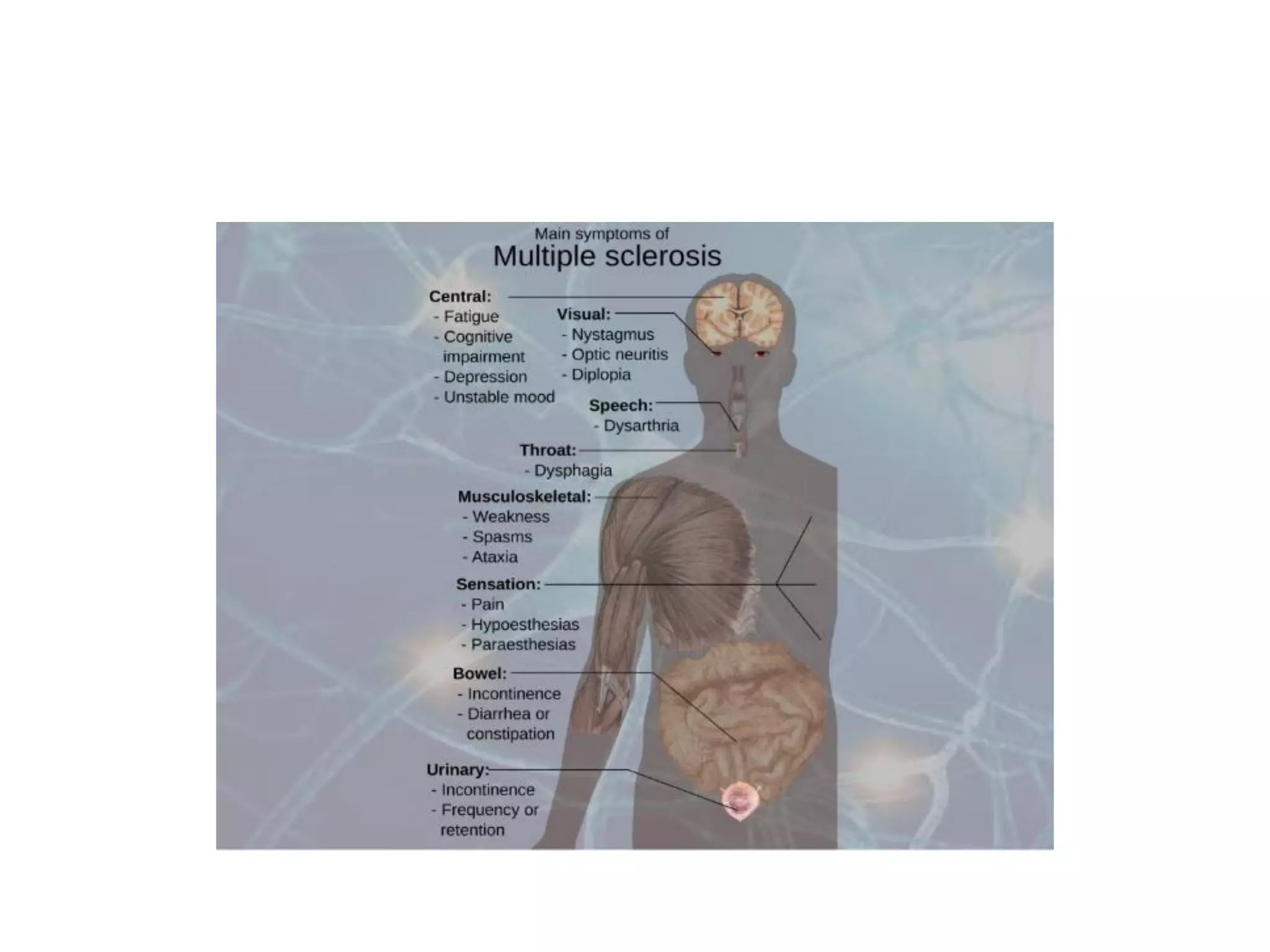 Multiple Sclerosis Pdf Multiple Sclerosis Pdf