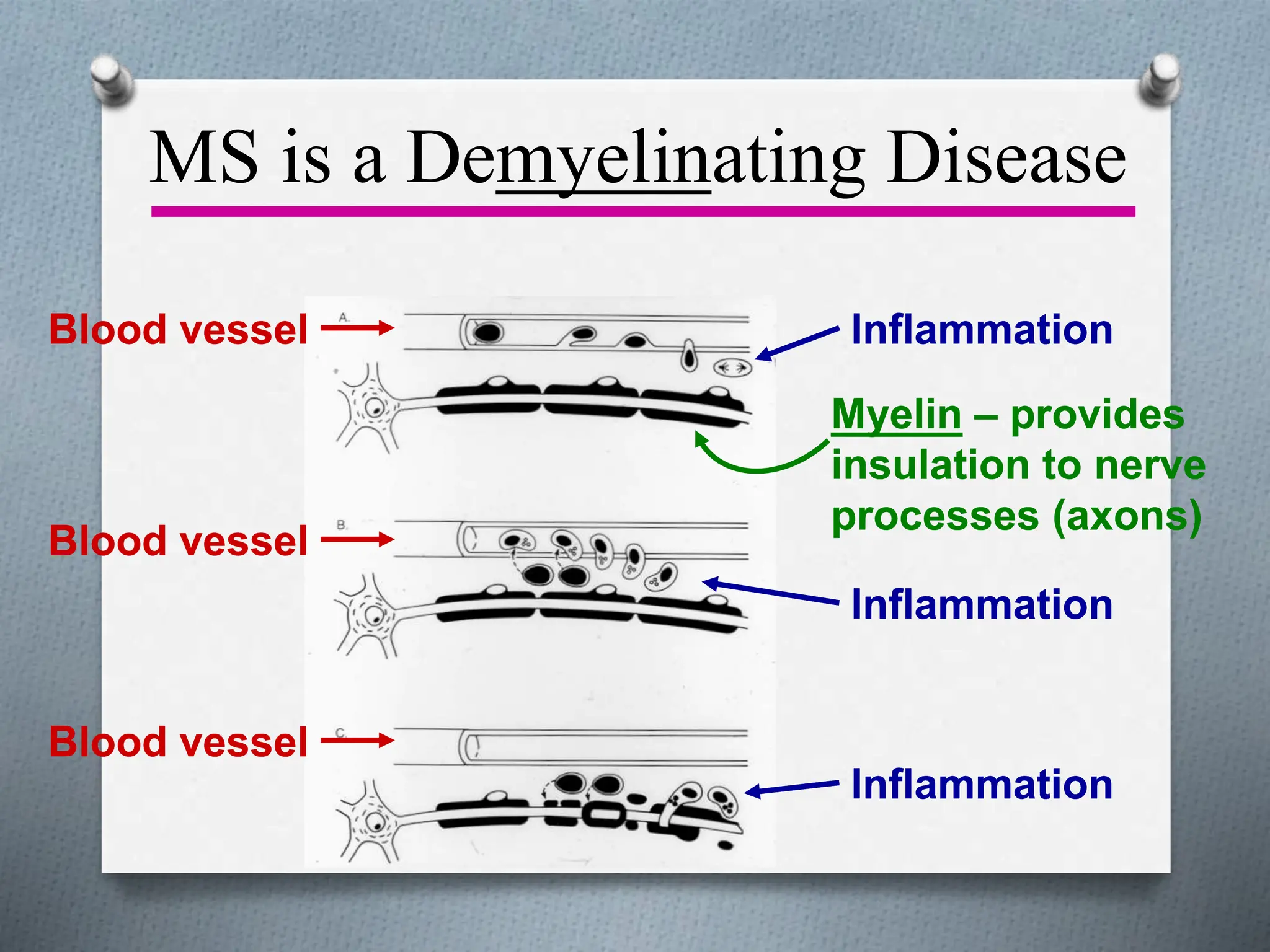 MS is a Demyelinating Disease
Myelin – provides
insulation to nerve
processes (axons)
Blood vessel
Blood vessel
Blood vessel
Inflammation
Inflammation
Inflammation
Myelin – provides
insulation to nerve
processes (axons)
Blood vessel
Blood vessel
Blood vessel
Blood vessel
Blood vessel
Blood vessel
Inflammation
Inflammation
Inflammation
Inflammation
Inflammation
Inflammation
 