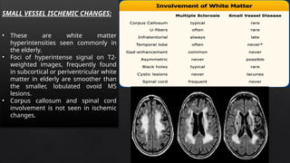 MULTIPLE SCLEROSIS a disease in detail.pptx
